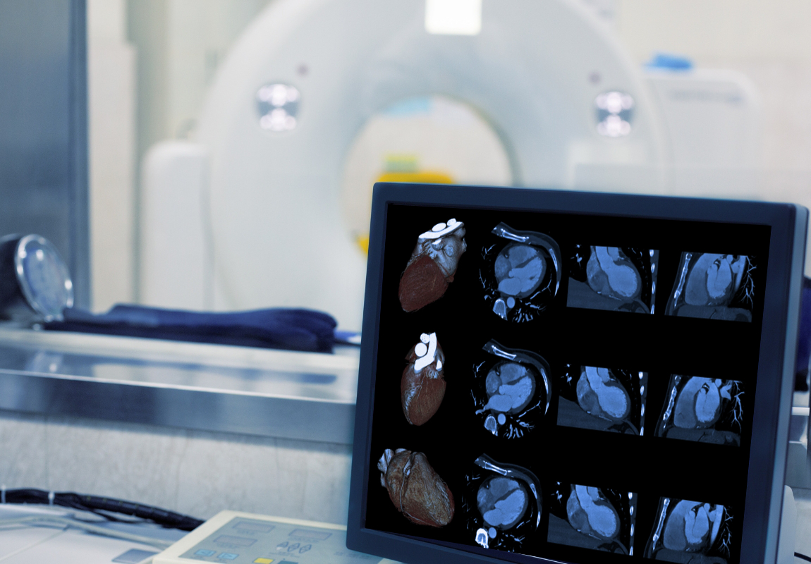 Die Beurteilung der Herzmuskeldurchblutung erfolgt nach Belastung